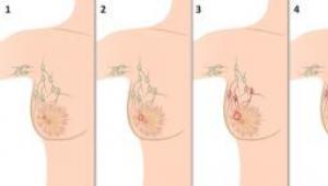 Как определить рак молочной железы у женщин: симптомы и причины
